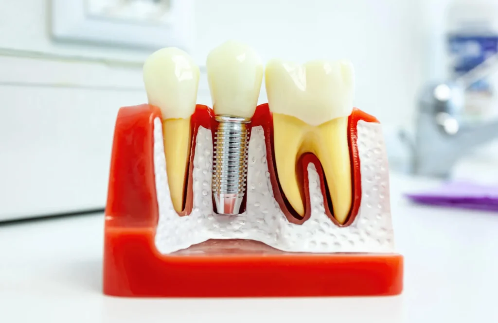 dental implants moody al model