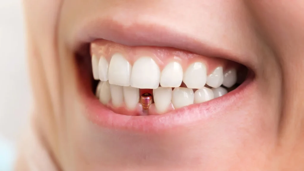 patient with dental implants moody al