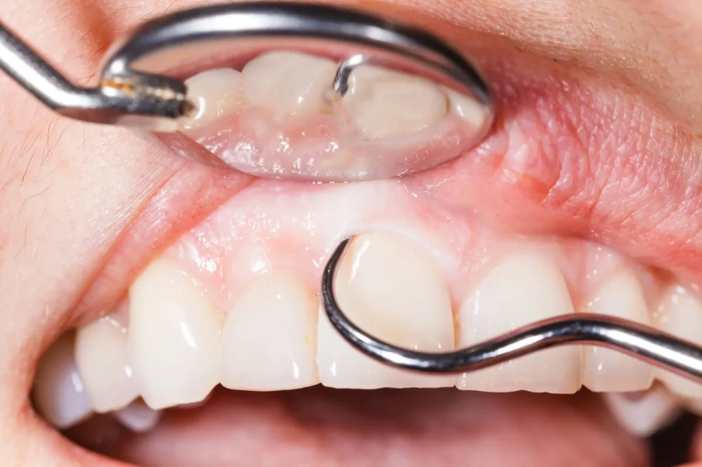 after periodontics Moody AL