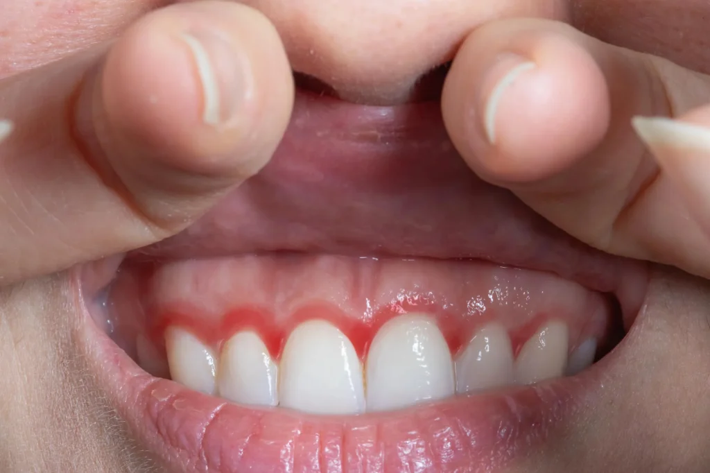 periodontics Moody AL patient