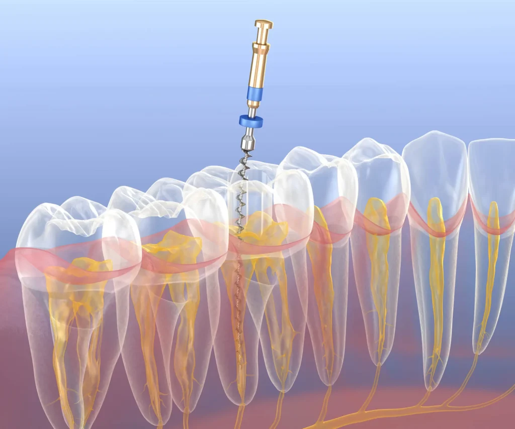 3D image of endodontics Moody AL