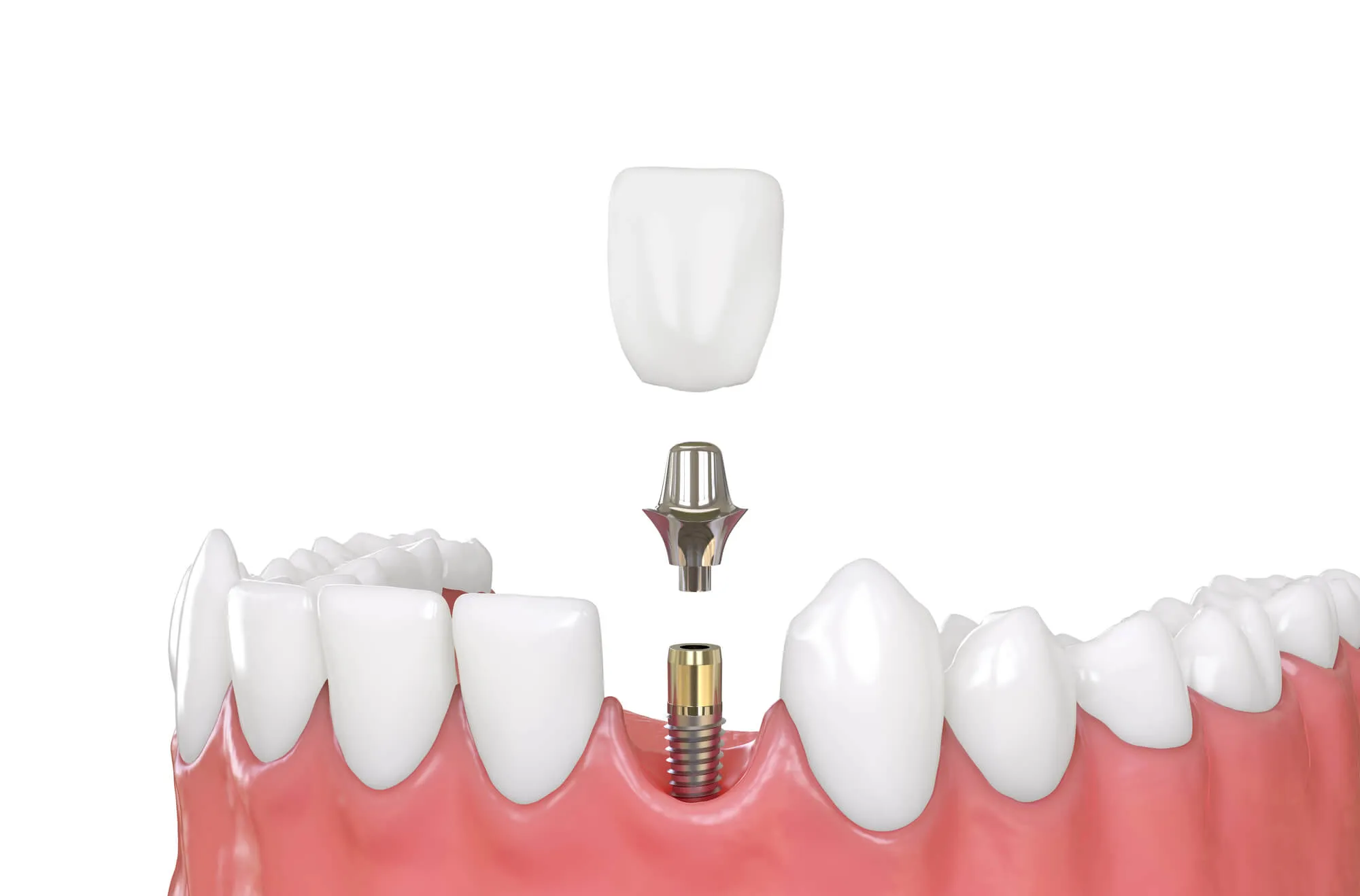 dental implants moody al illustration
