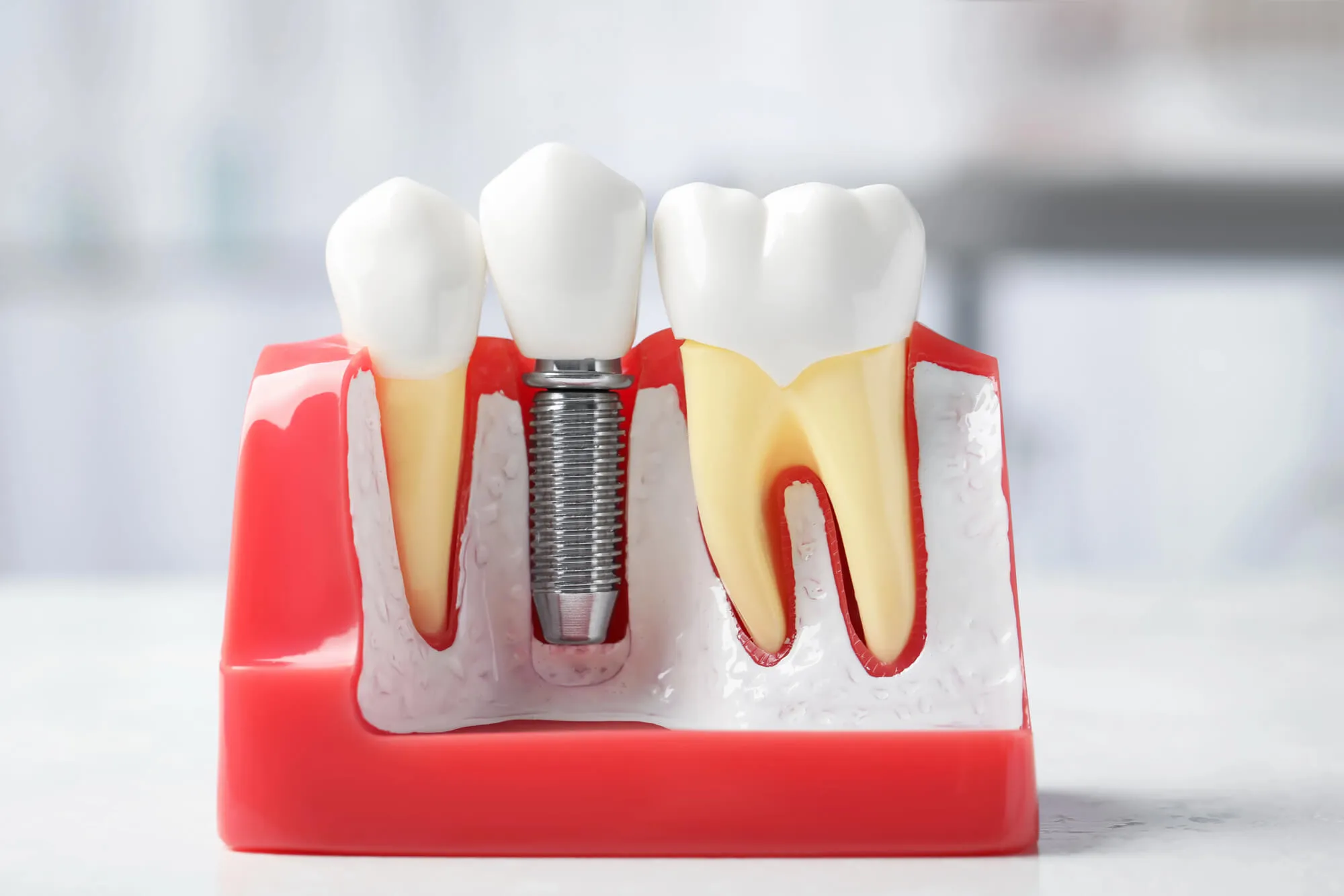 dental implants moody al model