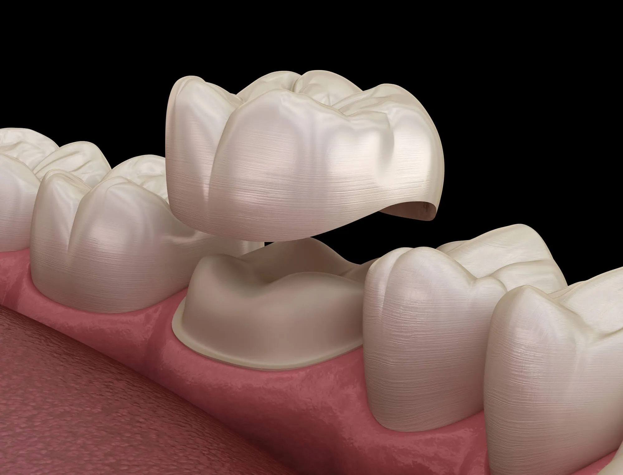 dentist in st. clair county shows an illustration of a crown
