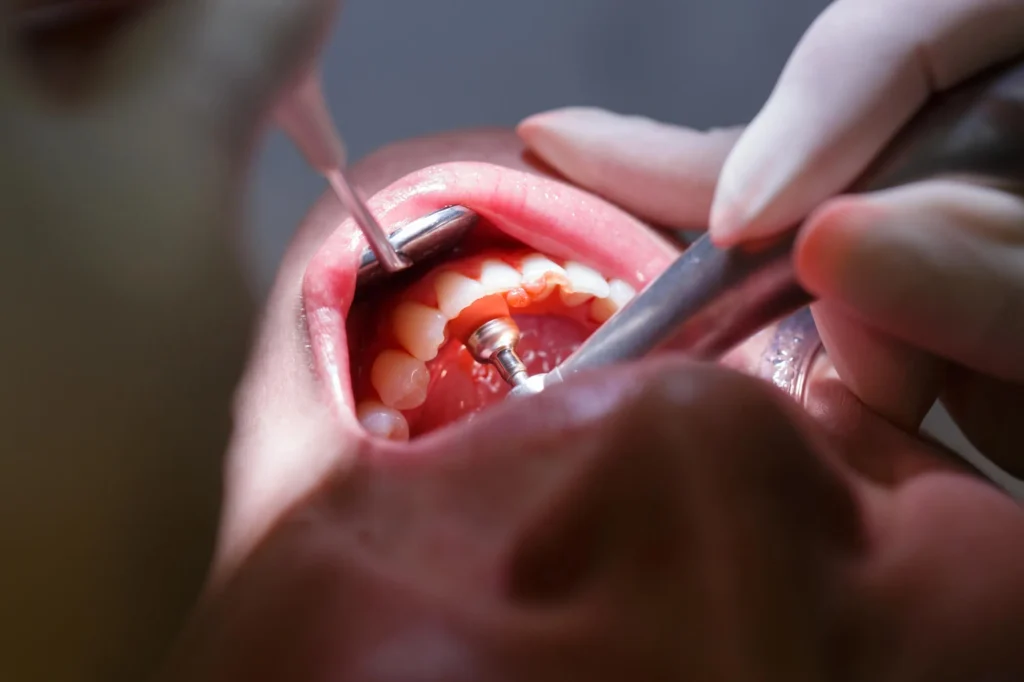 teeth-cleaning-at-a-dental-clinic-moody-al
